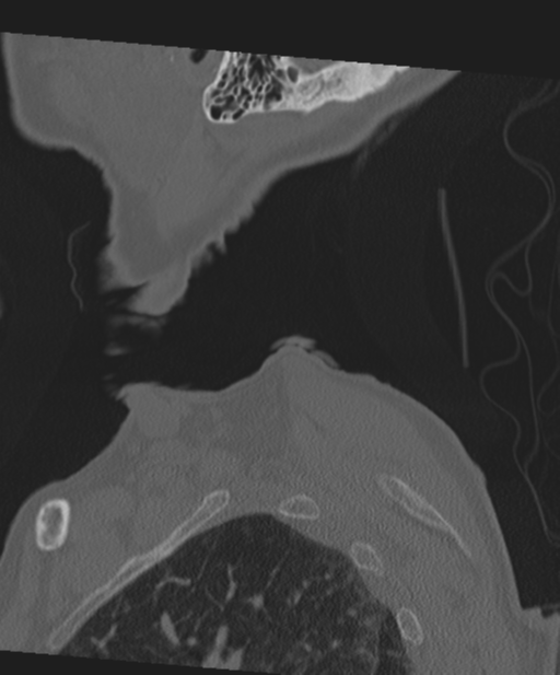 C2 fracture with vertebral artery dissection (Radiopaedia 37378-39199 Sagittal bone window 5).png