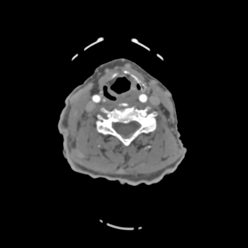 File:C2 fracture with vertebral artery dissection (Radiopaedia 37378-39200 A 120).png