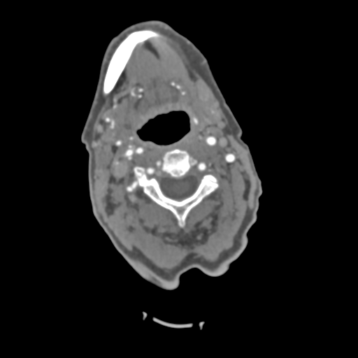 C2 fracture with vertebral artery dissection (Radiopaedia 37378-39200 A 155).png