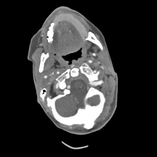 C2 fracture with vertebral artery dissection (Radiopaedia 37378-39200 A 177).png