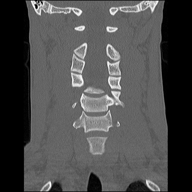 C5 facet fracture (Radiopaedia 58374-65499 Coronal bone window 30).jpg