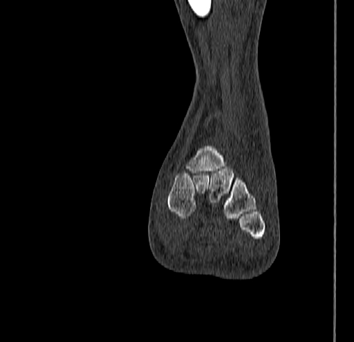 Calcaneal fracture - Sanders type 4 (Radiopaedia 90179-107370 Coronal bone window 49).jpg