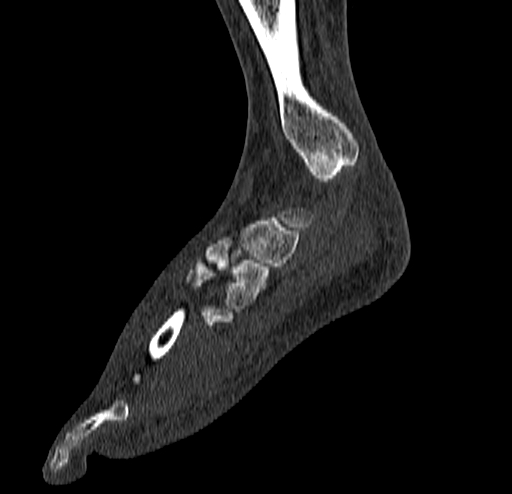 Calcaneal fracture - Sanders type 4 (Radiopaedia 90179-107370 Sagittal bone window 34).jpg