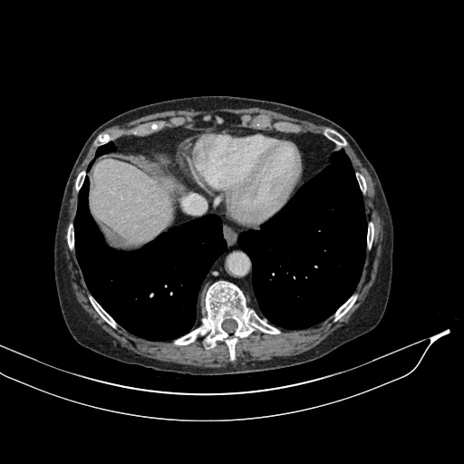 Calcified adrenal glands and Spigelian hernia (Radiopaedia 49741-54988 A 18).jpg