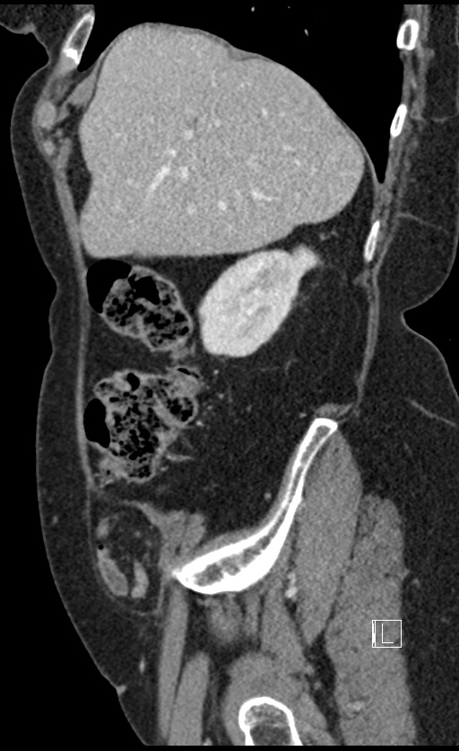 Calcified adrenal glands and Spigelian hernia (Radiopaedia 49741-54988 C 129).jpg
