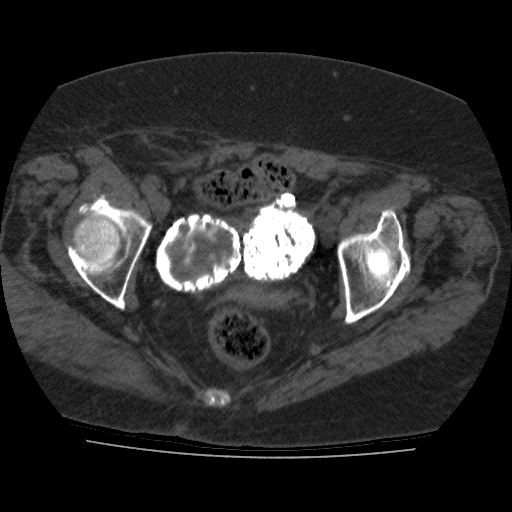 File:Calcified fibroids (Radiopaedia 16853-16579 non-contrast 10).jpg