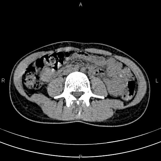 File:Calcified hepatic hydatid cyst (Radiopaedia 83870-99072 Axial non-contrast 101).jpg
