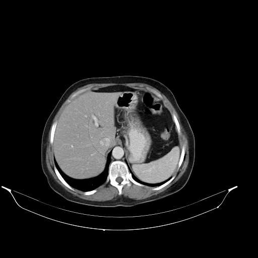 File:Calcified hydatid cyst of the liver (Radiopaedia 21212-21112 A 7).jpg