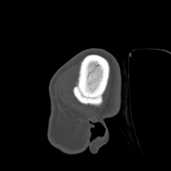 Calvarial osteoma (Radiopaedia 36520-38079 Sagittal bone window 103).jpg