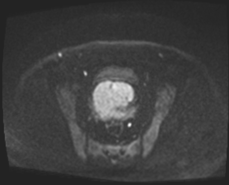Cancer cervix - stage IIb (Radiopaedia 75411-86615 Axial DWI 74).jpg