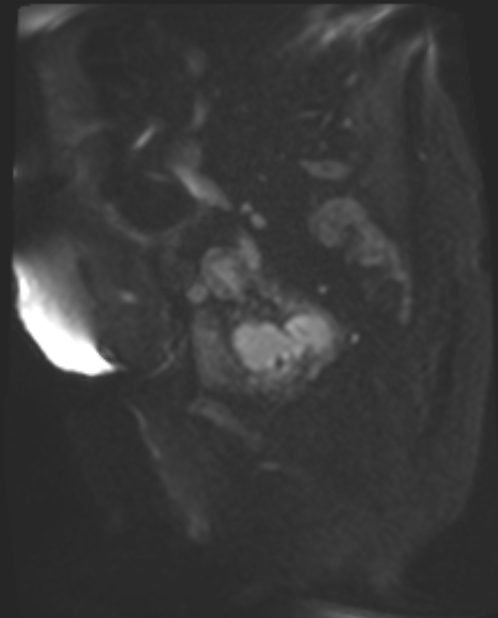 Cancer cervix - stage IIb (Radiopaedia 75411-86615 Sagittal DWI 55).jpg