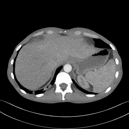 Cannonball metastases - testicular choriocarcinoma (Radiopaedia 84510-99891 B 96).jpg