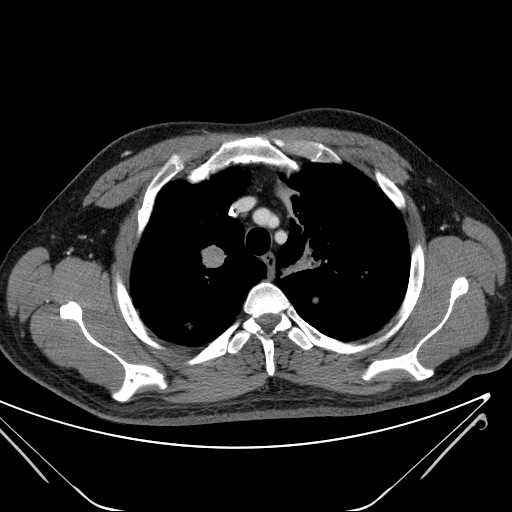 File:Cannonball pulmonary metastases (Radiopaedia 67684-77101 D 69).jpg