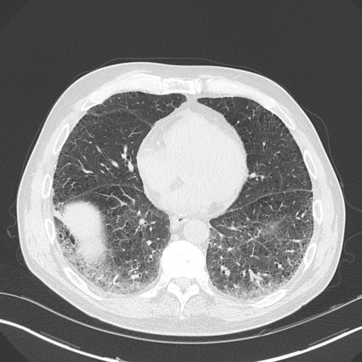 Caplan syndrome (Radiopaedia 56667-63530 Axial lung window 132).jpg