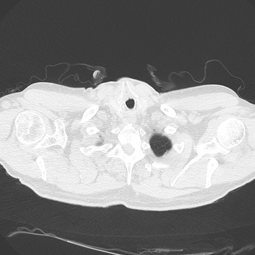 Caplan syndrome (Radiopaedia 56667-63530 Axial lung window 16).jpg