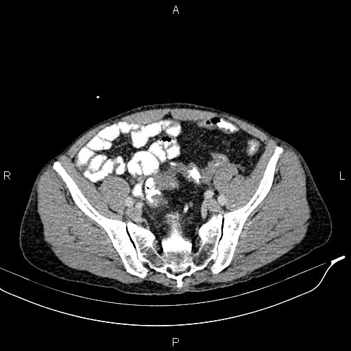 Caput medusae sign - portal hypertension (Radiopaedia 64007-72759 A 78).jpg