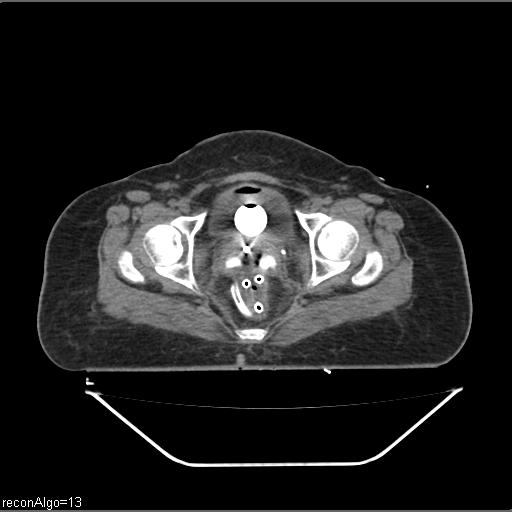 Carcinoma cervix- brachytherapy applicator (Radiopaedia 33135-34173 Axial non-contrast 34).jpg