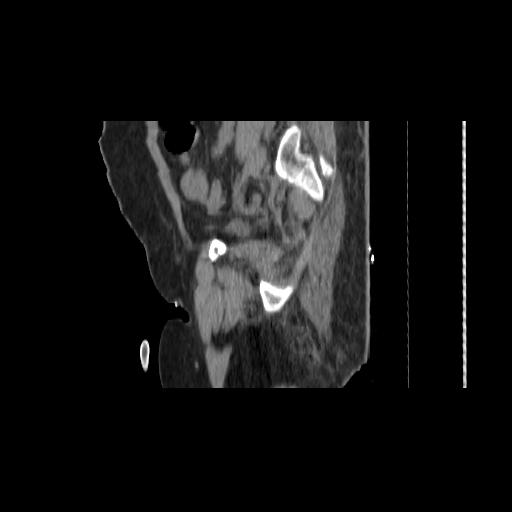 File:Carcinoma cervix- brachytherapy applicator (Radiopaedia 33135-34173 D 140).jpg