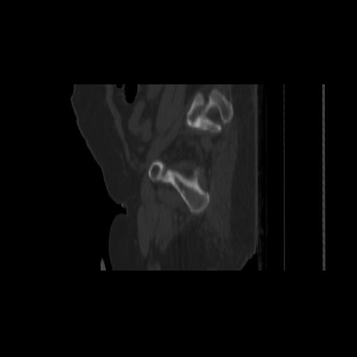 Carcinoma cervix- brachytherapy applicator (Radiopaedia 33135-34173 Sagittal bone window 150).jpg