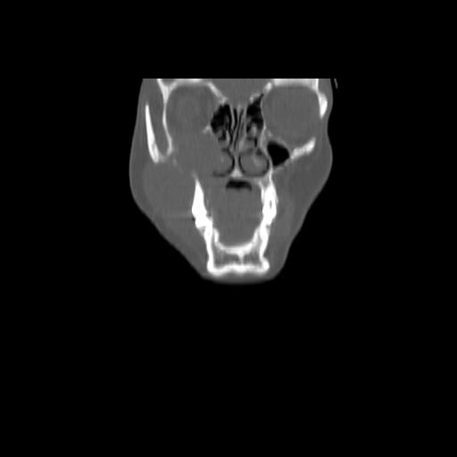 Carcinoma of the maxillary antrum (Radiopaedia 53805-59888 Coronal bone window 30).jpg