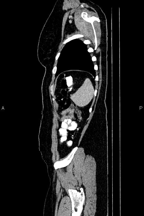 Carcinoma of uterine cervix (Radiopaedia 85861-101700 D 78).jpg
