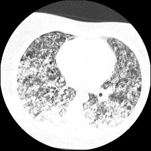 Cardiac angiosarcoma (Radiopaedia 66010-75181 Axial lung window 42).jpg