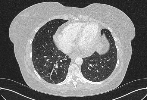 Cardiac sarcoidosis (Radiopaedia 74548-85534 Axial lung window 63).jpg