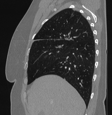 File:Cardiac sarcoidosis (Radiopaedia 74548-85534 Sagittal lung window 70).jpg