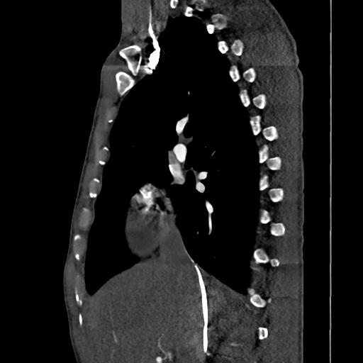 Cardiac tumor - undifferentiated pleomorphic sarcoma (Radiopaedia 45844-50134 B 50).png