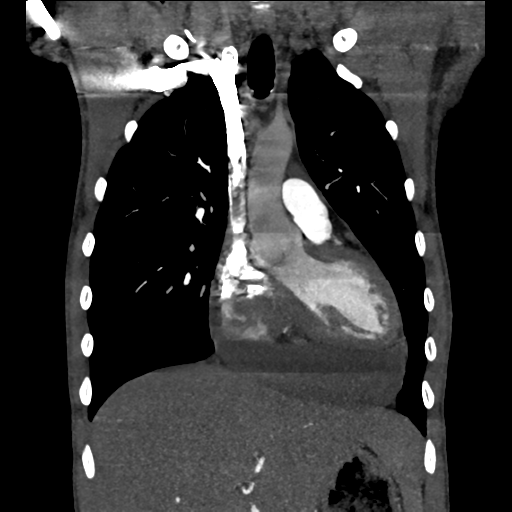 Cardiac tumor - undifferentiated pleomorphic sarcoma (Radiopaedia 45844-50134 Coronal non-contrast 25).png