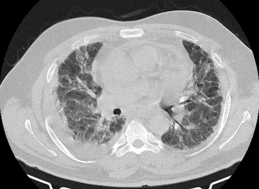 Cardiogenic pulmonary edema (Radiopaedia 68180-77678 Axial lung window 46).jpg