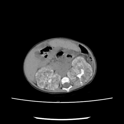 Caroli disease with autosomal recessive polycystic kidney disease (ARPKD) (Radiopaedia 89651-106703 E 106).jpg