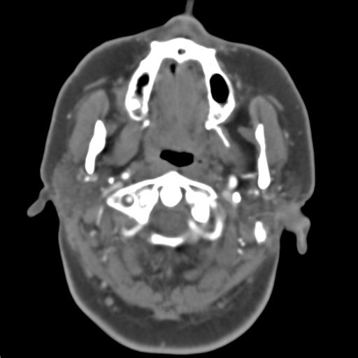 Carotico ophthalmic aneurysm (Radiopaedia 42916-46148 A 51).png