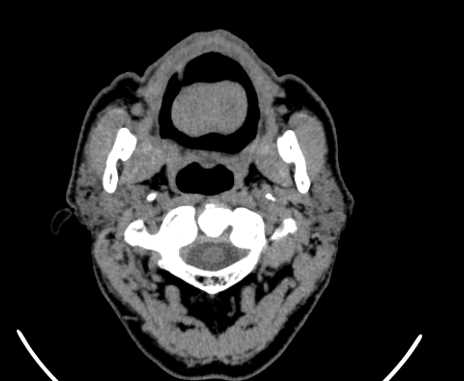 Carotid body tumor (Radiopaedia 61750-69757 Axial non-contrast 16).jpg