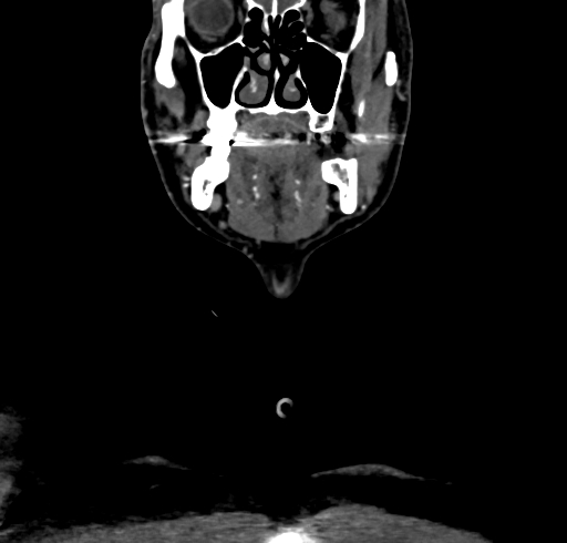 File:Carotid body tumor (Radiopaedia 83615-98727 B 26).jpg