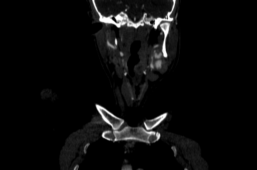 File:Carotid bulb pseudoaneurysm (Radiopaedia 57670-64616 D 7).jpg