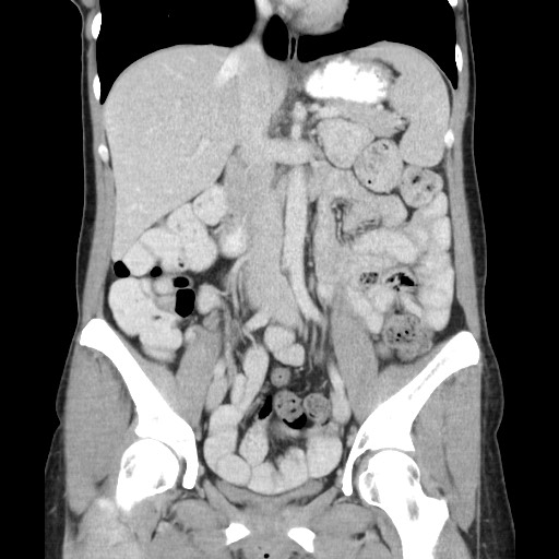 Castleman disease with fibrous pseudotumor in the abdomen (Radiopaedia 77296-89373 B 46).jpg