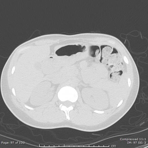 Catamenial pneumothorax (Radiopaedia 54382-60600 Axial non-contrast 97).jpg