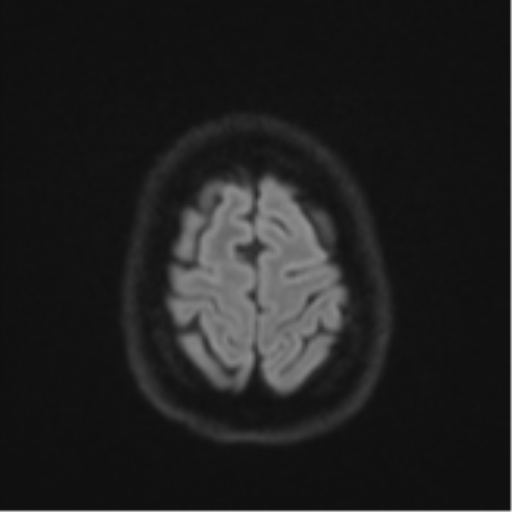 File:Cavernoma with bleed - midbrain (Radiopaedia 54546-60774 Axial DWI 52).png