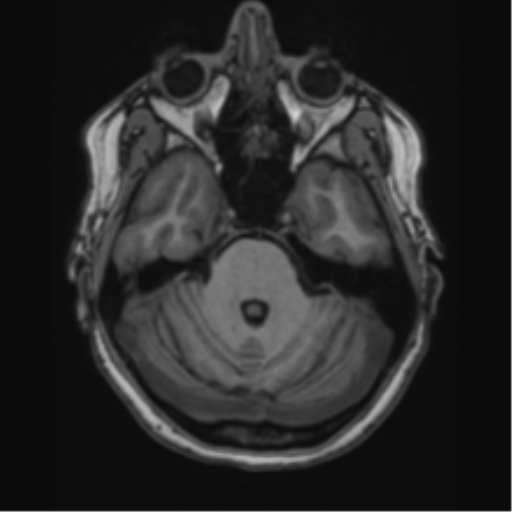 Cavernoma with bleed - midbrain (Radiopaedia 54546-60774 Axial T1 5).png