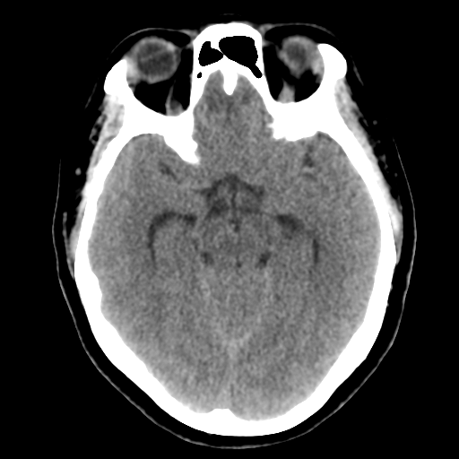 Cavernoma with hemorrhage (Radiopaedia 70755-80931 Axial non-contrast 22).png