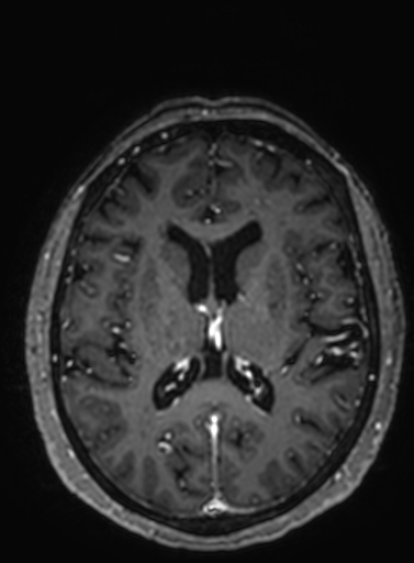 Cavernous hemangioma of the cerebellar falx (Radiopaedia 73025-83724 Axial T1 C+ 147).jpg