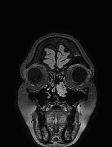 Cavernous hemangioma of the cerebellar falx (Radiopaedia 73025-83724 Coronal FLAIR 20).jpg