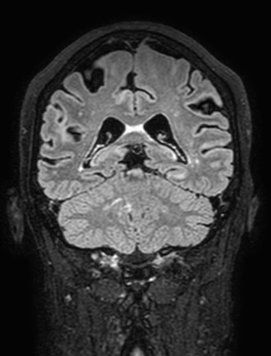 Cavernous hemangioma of the cerebellar falx (Radiopaedia 73025-83724 Coronal FLAIR 236).jpg