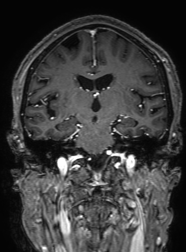 Cavernous hemangioma of the cerebellar falx (Radiopaedia 73025-83724 Coronal T1 C+ 199).jpg