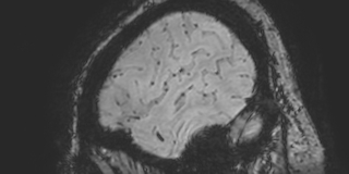 File:Cavernous hemangioma of the cerebellar falx (Radiopaedia 73025-83724 Sagittal BOLD 180).jpg