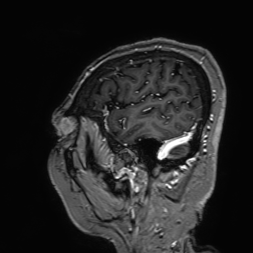 File:Cavernous hemangioma of the cerebellar falx (Radiopaedia 73025-83724 Sagittal T1 C+ 32).jpg