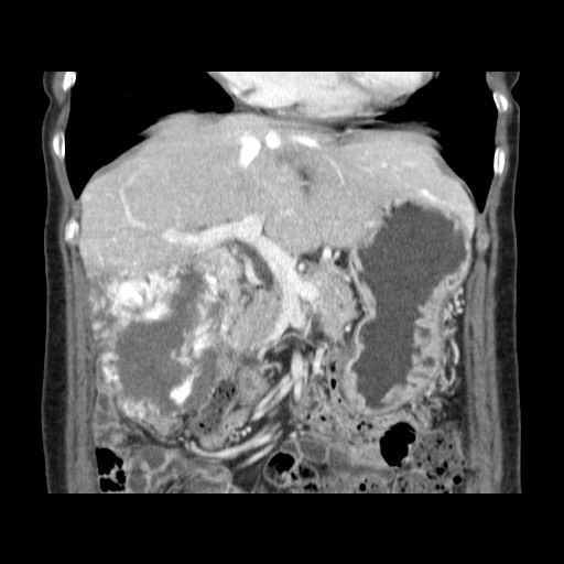 Cavernous hepatic hemangioma (Radiopaedia 75441-86667 C 54).jpg