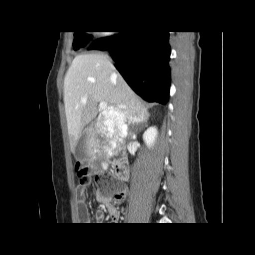 Cavernous hepatic hemangioma (Radiopaedia 75441-86667 D 72).jpg