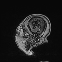 Cavernous sinus meningioma (Radiopaedia 63682-72367 Sagittal T1 C+ 154).jpg